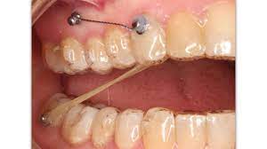 ¿Qué son los minitornillos o miniimplantes de ortodoncia?